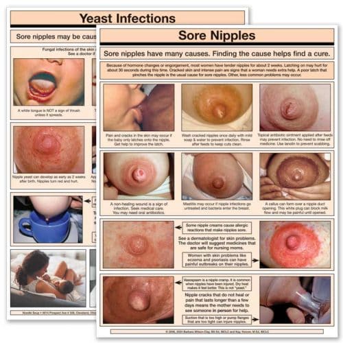 Sore Nipples & Yeast Infection tear pad